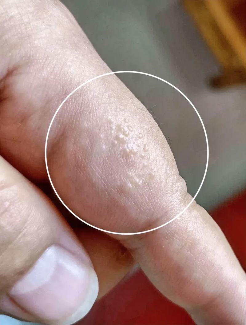 手上长这种透明小水疱,千万别挑破!