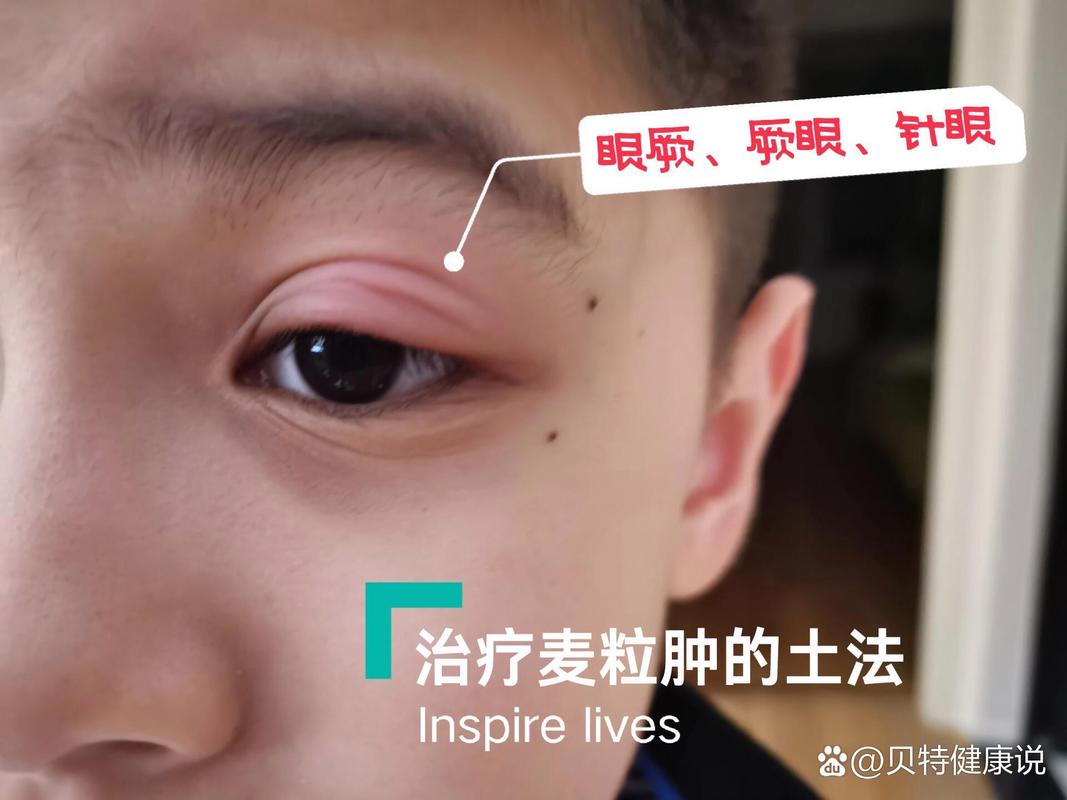 眼睑上长了麦粒肿该怎么办?