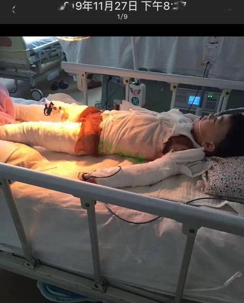 黑龙江8岁女童严重烧伤,疼痛难忍却懂事得让人心疼……