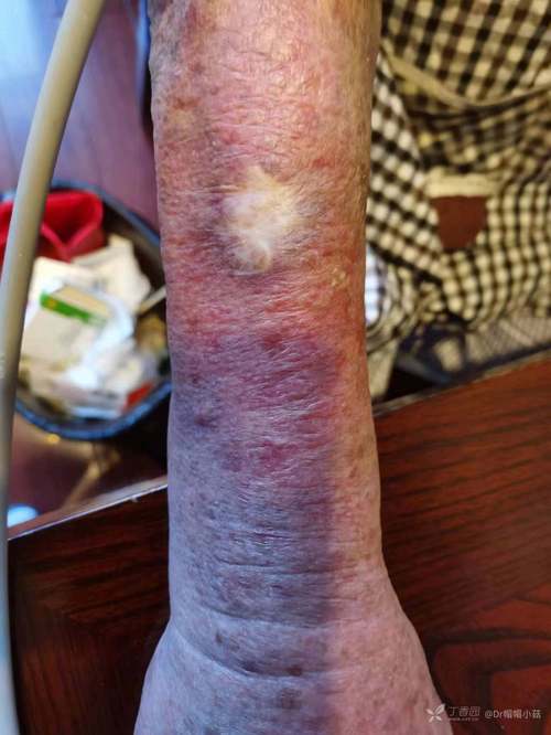 一钻进被窝就发作,身上出现道道“血痕”!最近杭州人扎堆看皮肤科,什么情况?