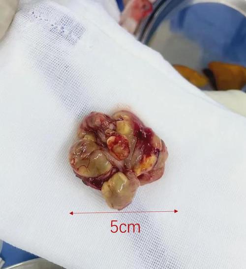 腹膜后巨大肿瘤!衡阳市中心医院小儿外科精准剥离